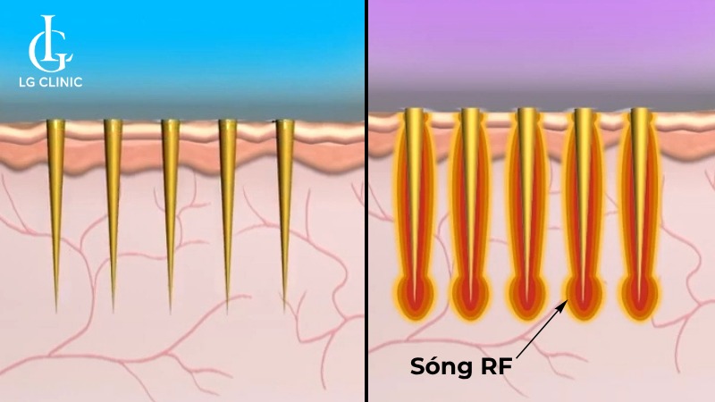 spa trị rạn da uy tín
