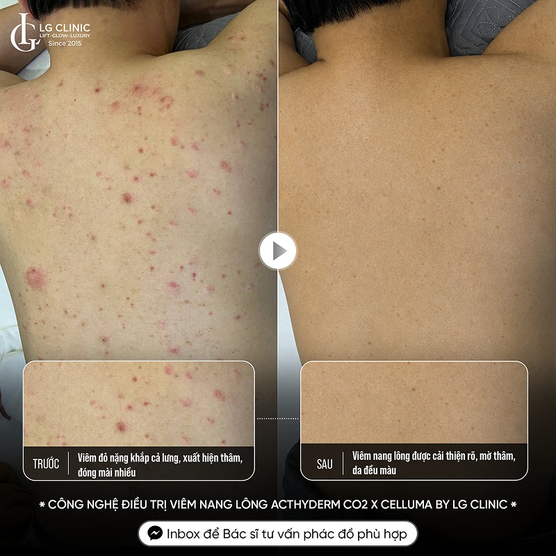sữa tắm trị mụn lưng