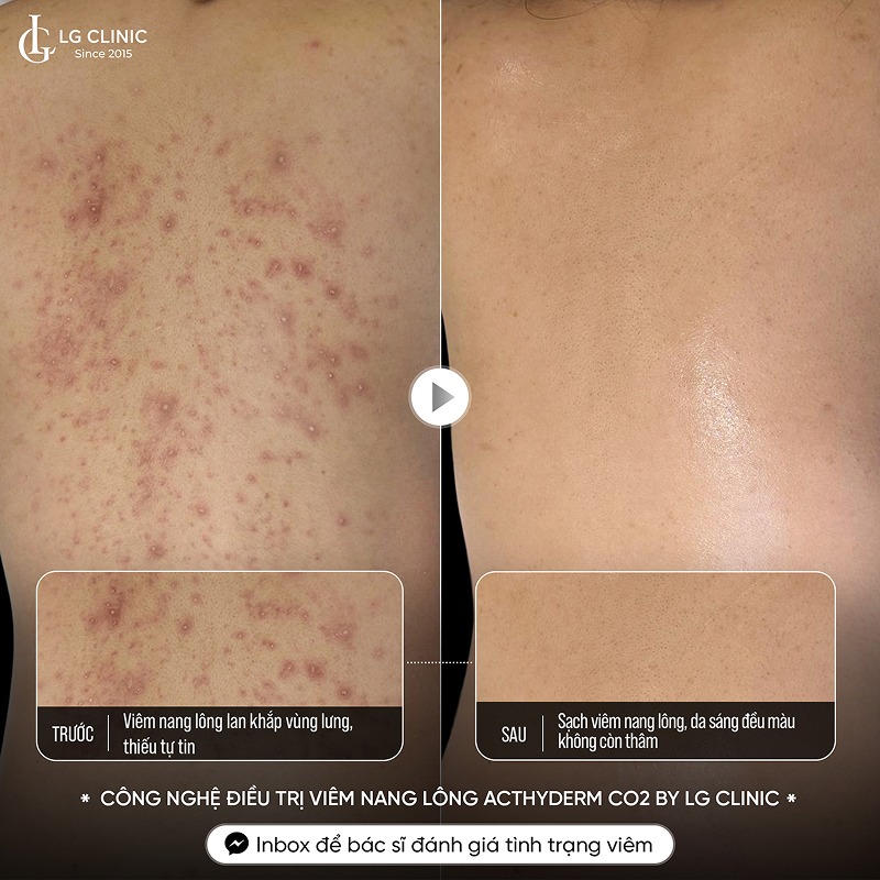 sữa tắm trị mụn lưng