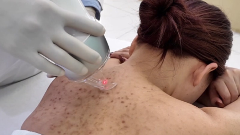 sữa tắm trị mụn lưng