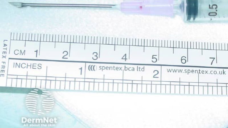 bóc tách sẹo là gì và khi nào cần áp dụng trong điều trị sẹo rỗ