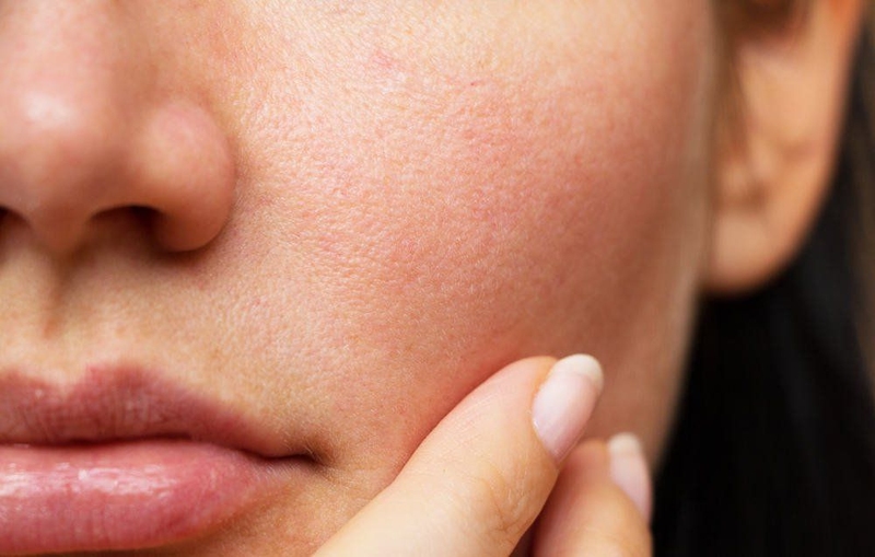 Da mỏng, khô và mất độ căng do lão hóa nội tại