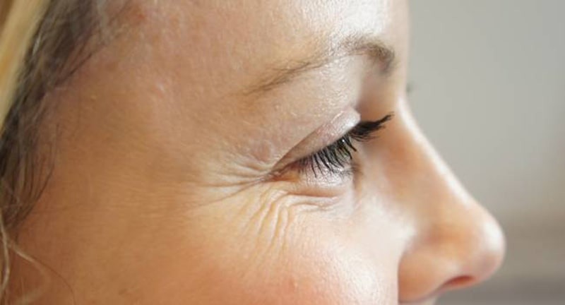 Vết chân chim đuôi mắt, ví dụ điển hình của nếp nhăn động do co cơ