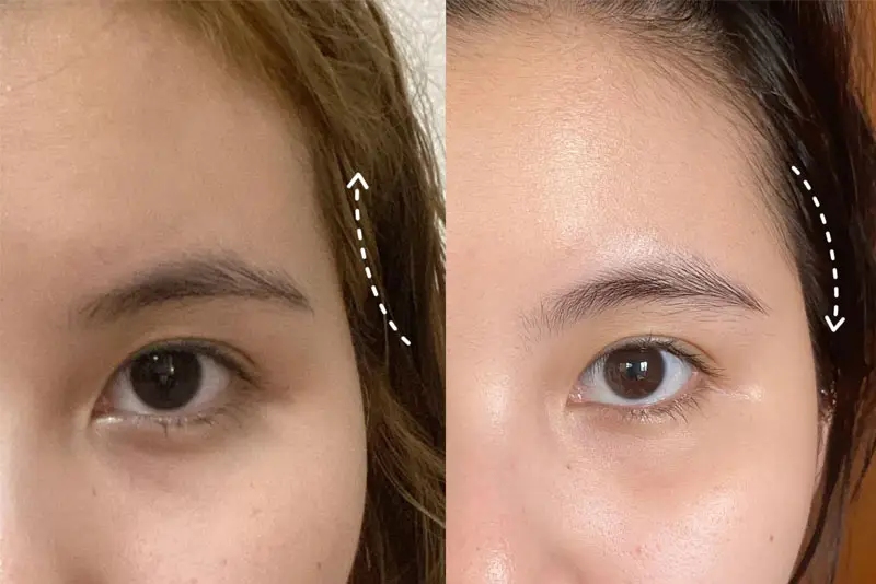 Hõm thái dương do mất thể tích mô mềm
