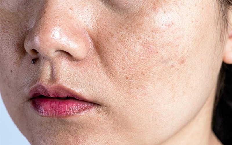Đốm nâu, nám và nền da không đều màu do photoaging