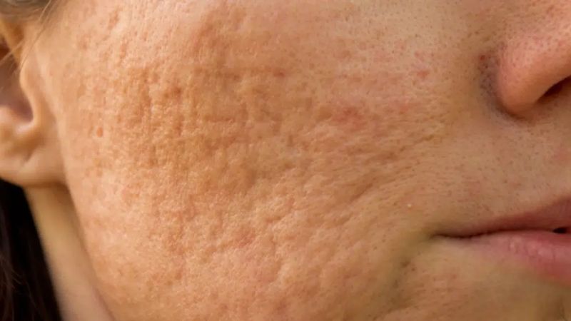 các loại sẹo rỗ và cách điều trị hiệu quả