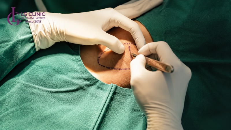 Cắt tuyến mồ hôi nách
