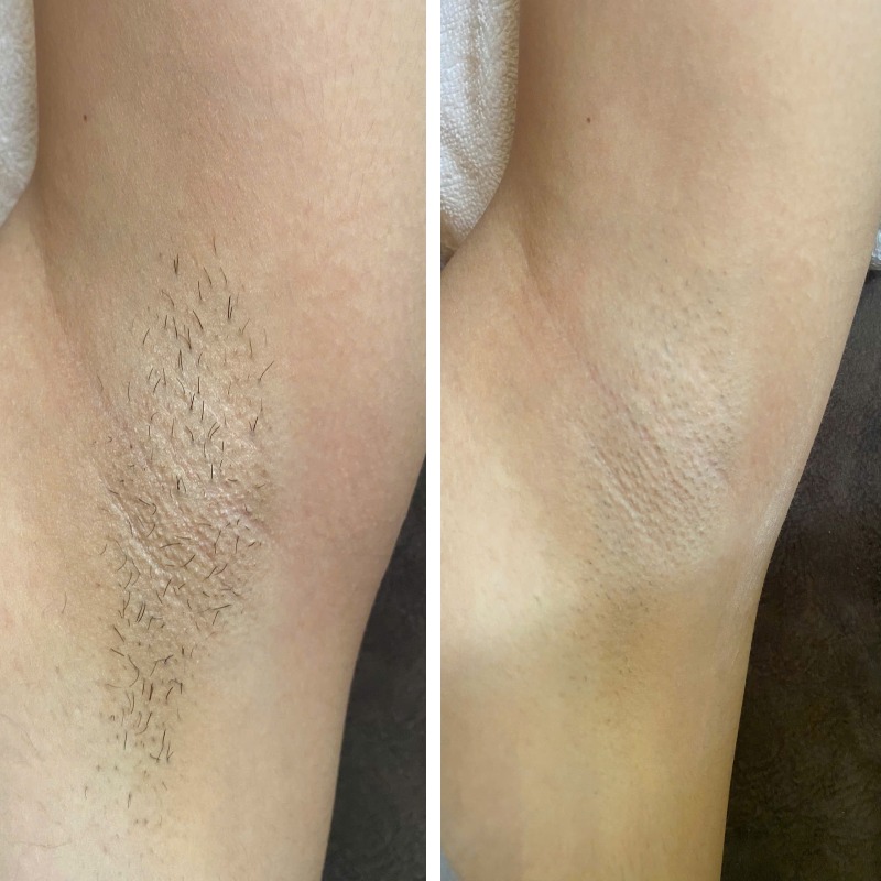 Cắt tuyến mồ hôi nách