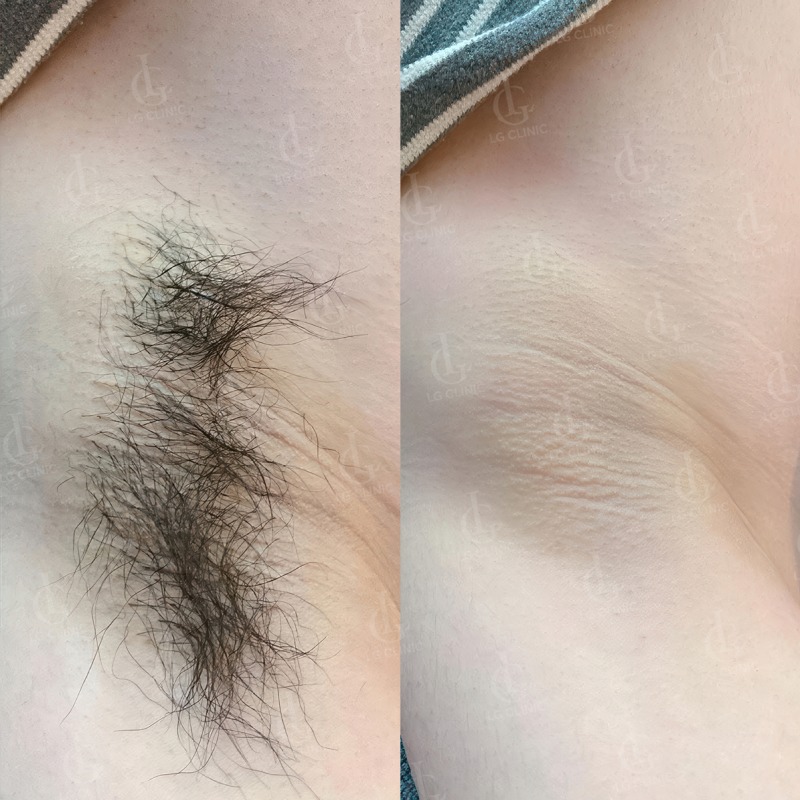 Cắt tuyến mồ hôi nách