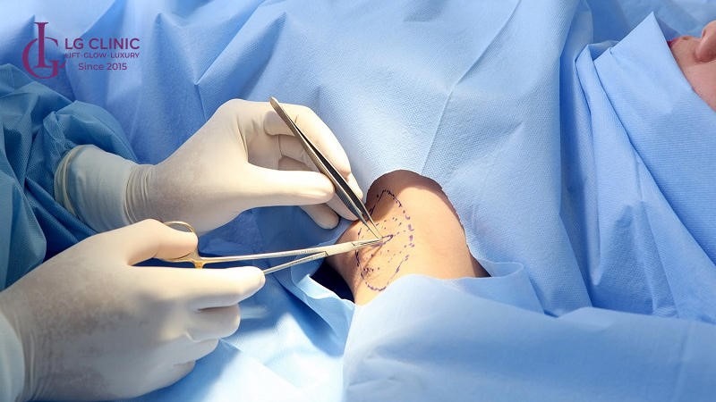 Cắt tuyến mồ hôi nách ở đâu tốt