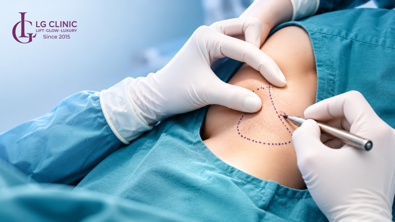 Cắt tuyến mồ hôi nách ở đâu tốt