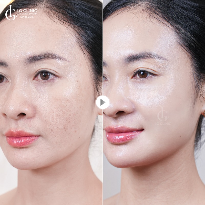Chi phí thu nhỏ lỗ chân lông bao nhiêu