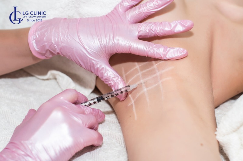 công nghệ trị hôi nách mới nhất