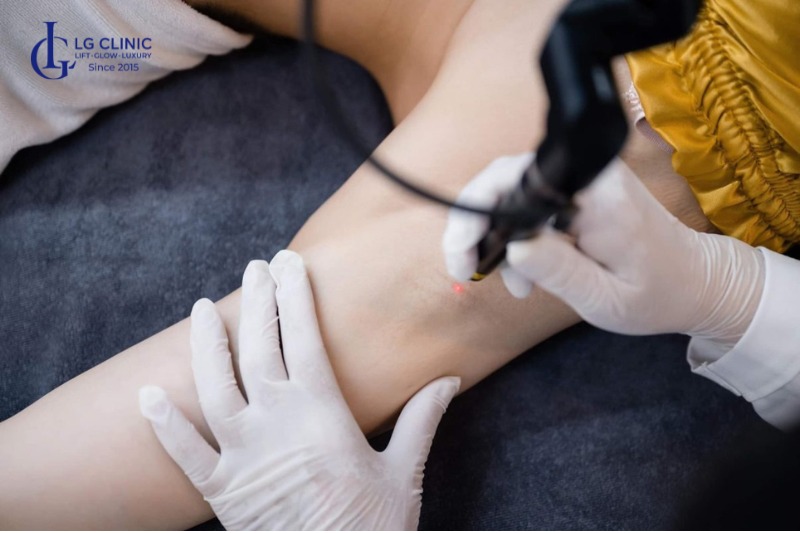 công nghệ trị hôi nách mới nhất