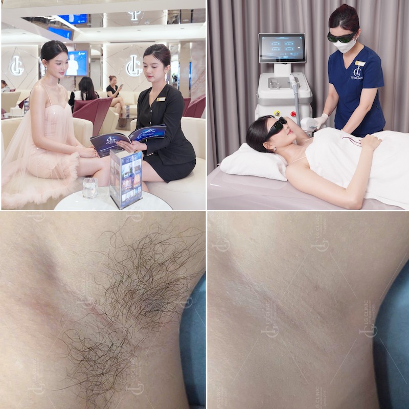 công nghệ trị hôi nách mới nhất