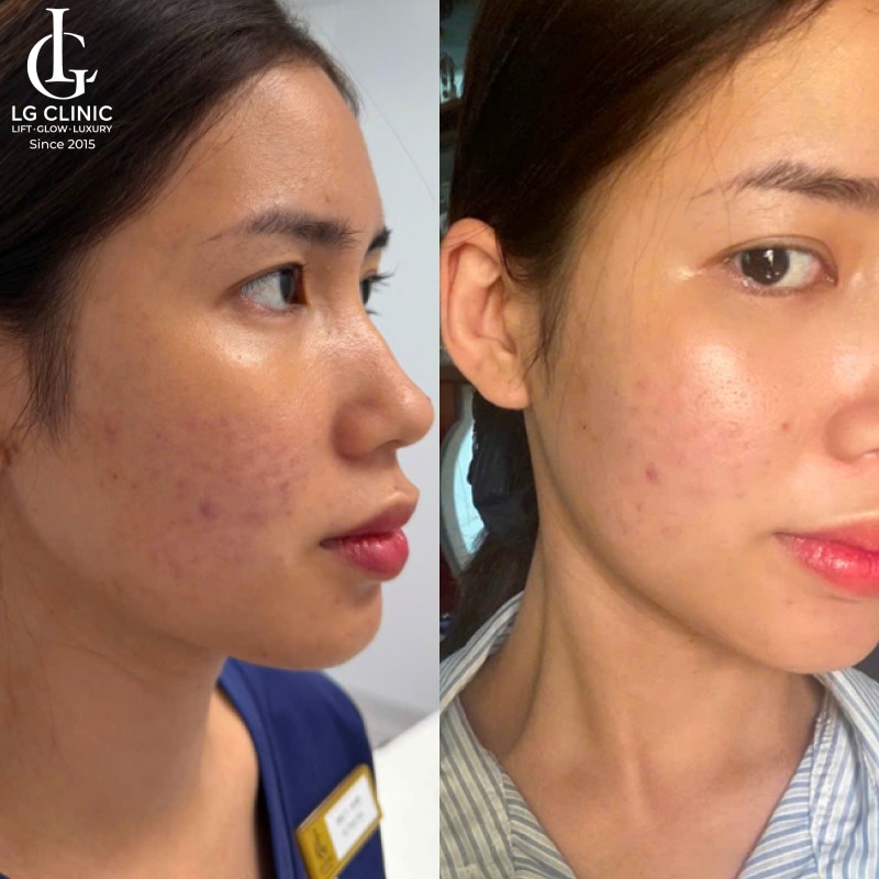 Công nghệ trị thâm