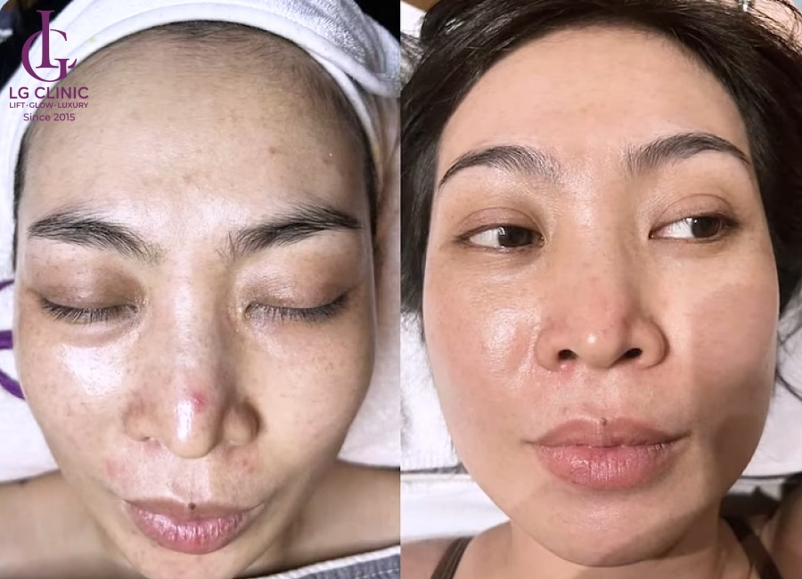 Công nghệ trị thâm