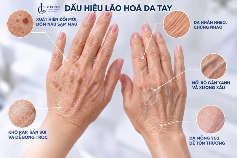 Dấu hiệu lão hóa da tay