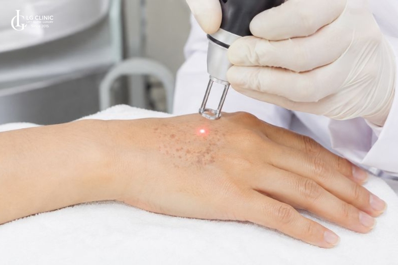 Điều trị đốm nâu và đồi mồi trên da tay bằng công nghệ laser