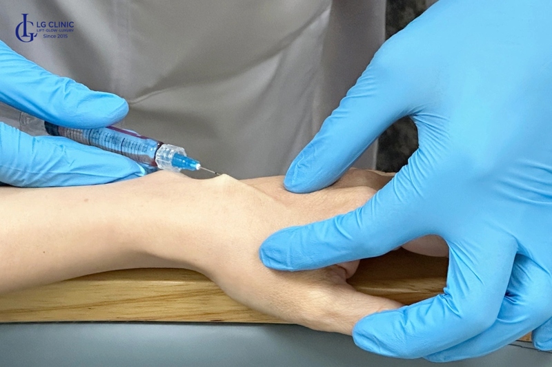 Tiêm filler để khắc phục tình trạng da tay lão hoá gầy guộc