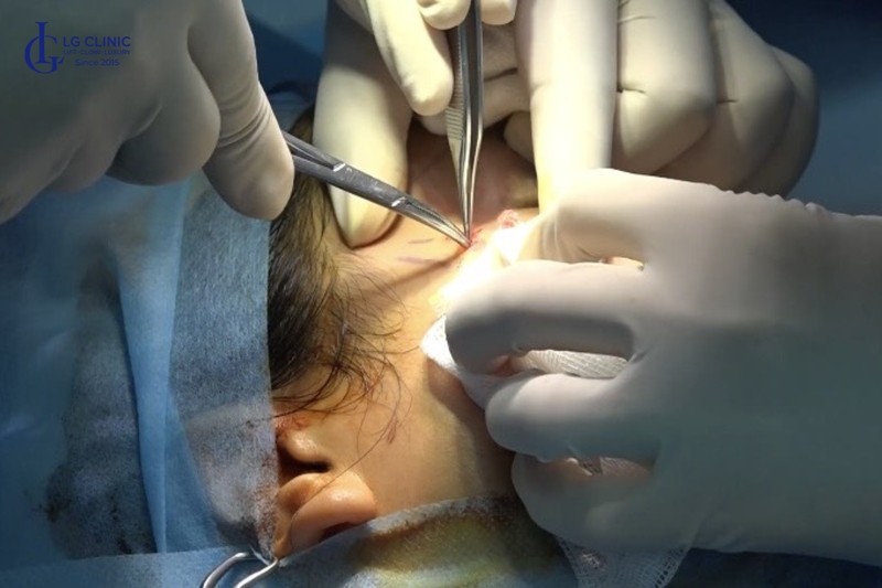 Sau 50 tuổi có thể can thiệp phẫu thuật căng da để điều trị lão hoá