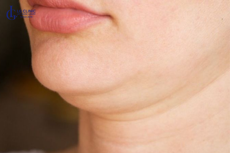 
Viền hàm kém sắc nét, xuất hiện nọng cằm do mô nâng đỡ chùng nhão 