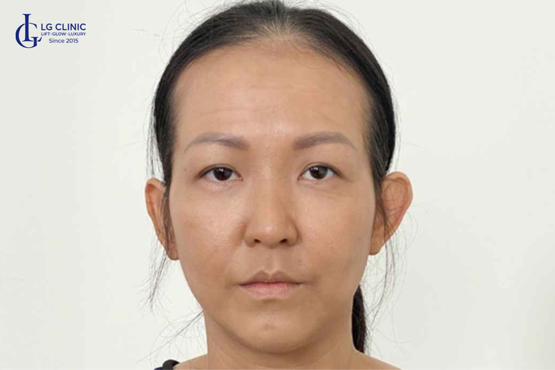 Má hóp, thái dương lõm khiến gương mặt hốc hác và già hơn tuổi 