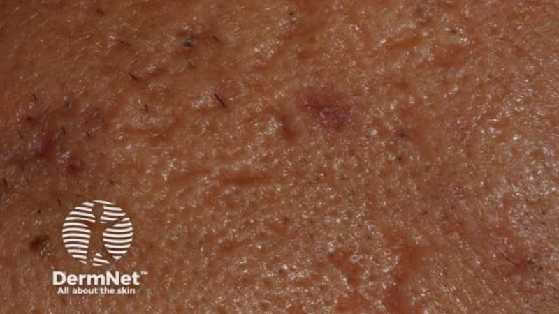 những loại sẹo rổ có thể dùng phương pháp bóc tách sẹo để điều trị