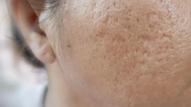 sẹo đáy hộp là một loại sẹo rỗ khó điều trị