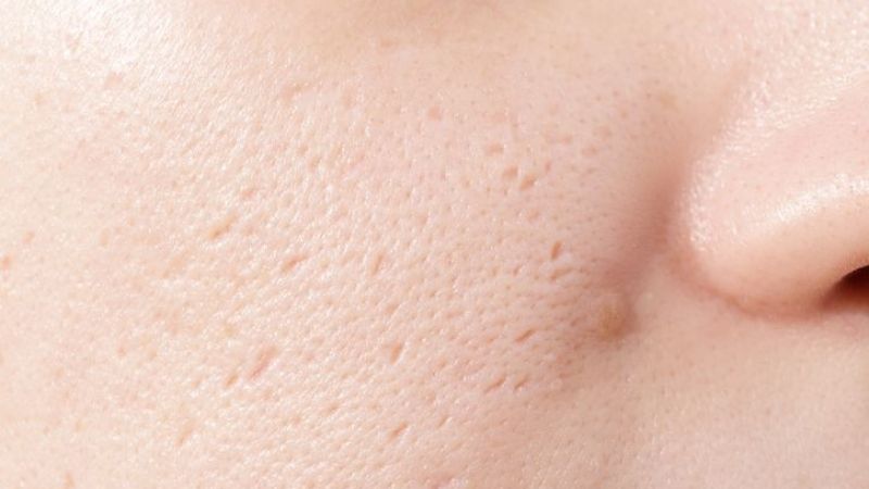 loại sẹo rỗ khó điều trị nhất