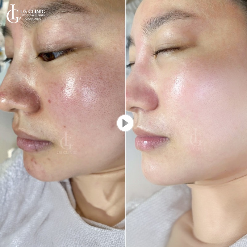 spa thu nhỏ lỗ chân lông Bình Dương