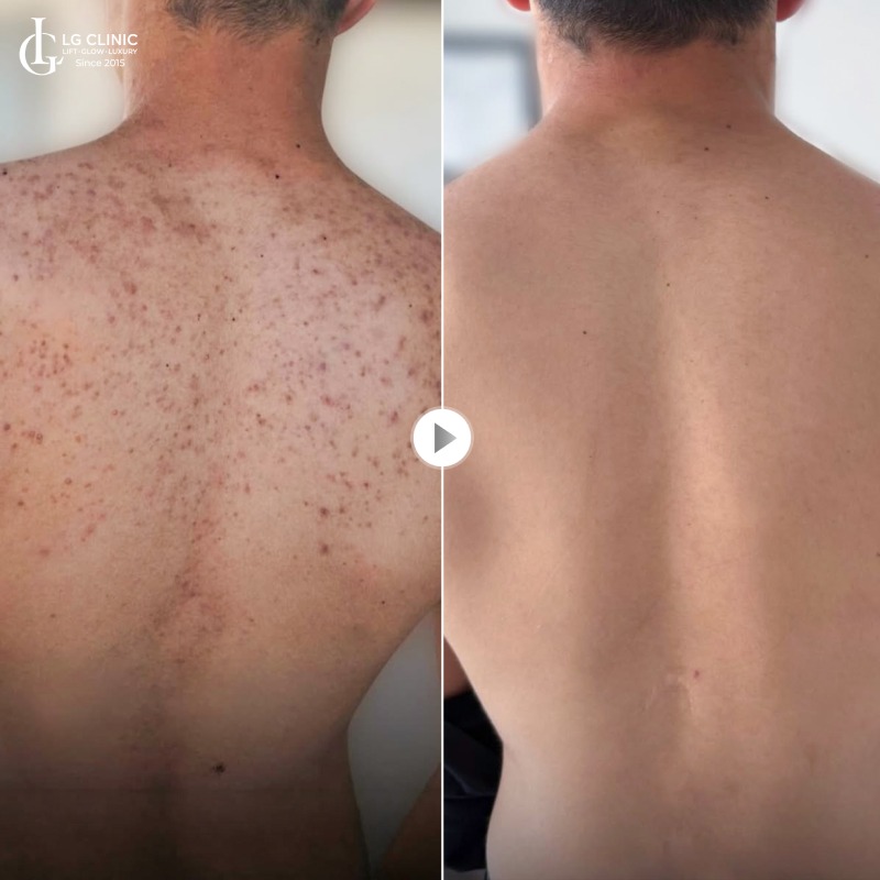 Tắm lá gì trị mụn lưng