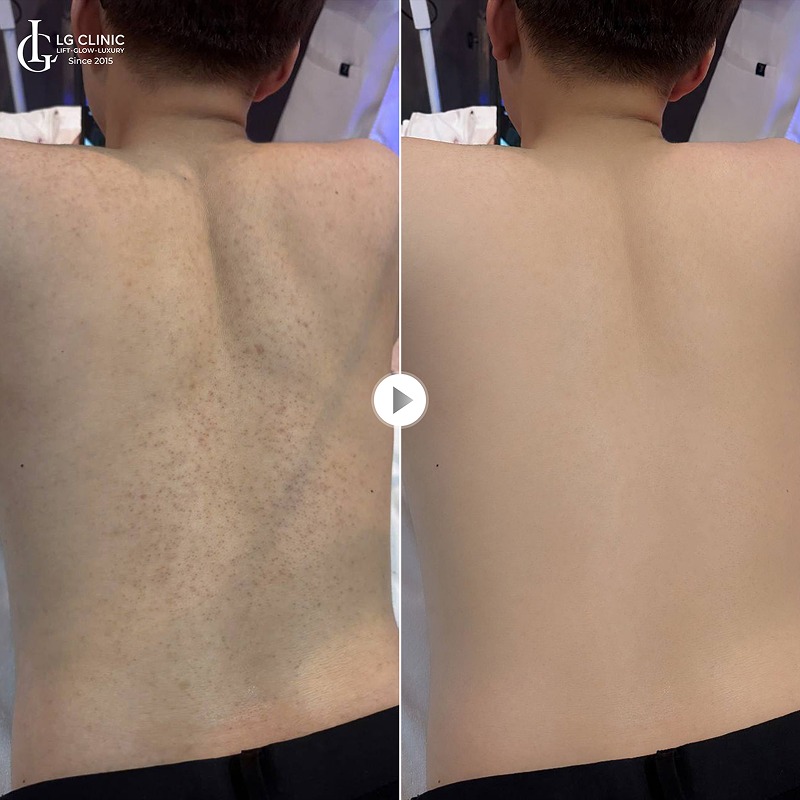 Tắm lá gì trị mụn lưng