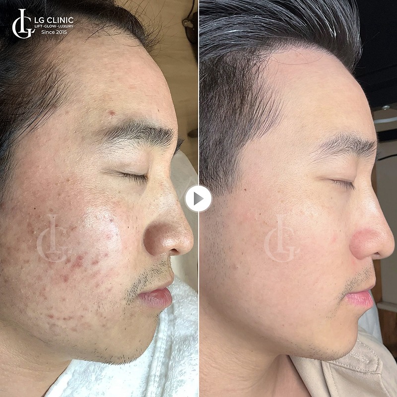 Trị mụn hay trị thâm trước