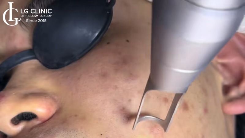 Trị mụn hay trị thâm trước