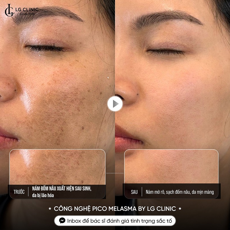 trị nám bằng lá lốt