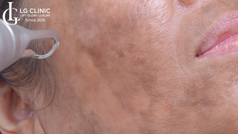 Trị nám bằng laser có hiệu quả không