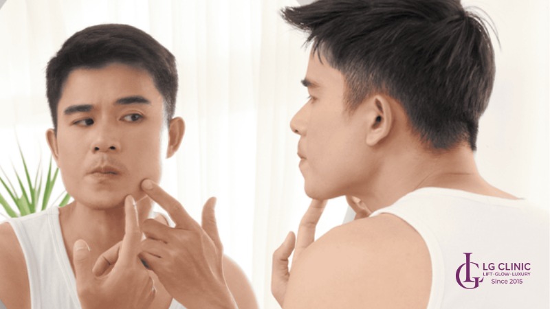 trị thâm mụn cho nam