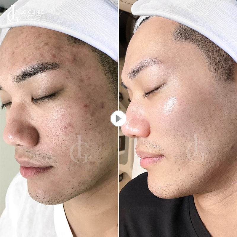 trị thâm mụn cho nam