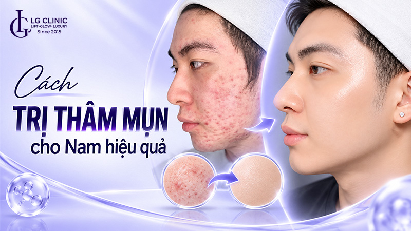 Cách trị thâm mụn cho nam