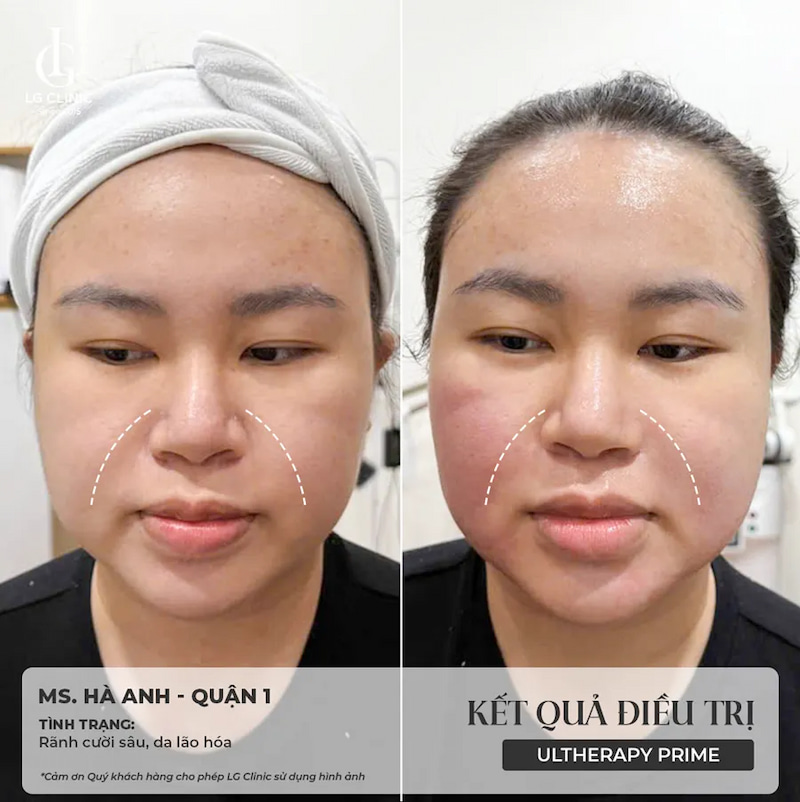 Kết quả sau khi điều trị Ultherapy Prime tại LG Clinic